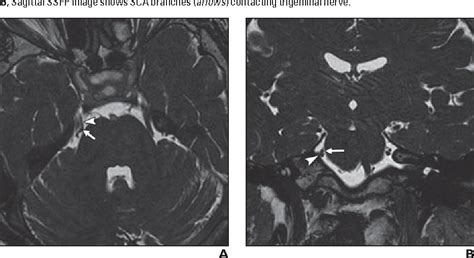 Mri Of The Trigeminal Nerve In Patients With Trigeminal Neuralgia Secondary To Vascular