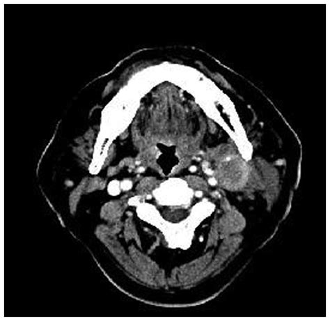 Deep Neck Abscess As The Predominant Initial Presentation Of Carcinoma
