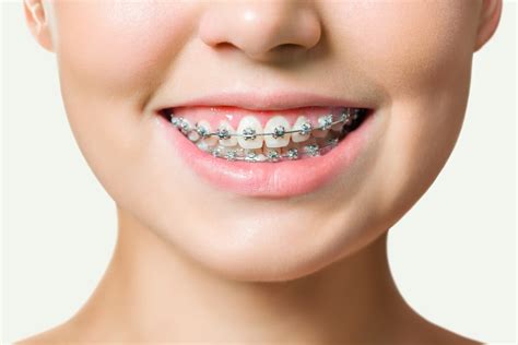 All About Dental Braces Apollo Hospitals Blog
