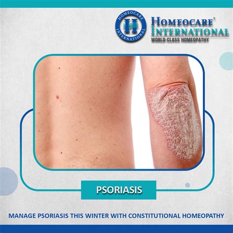 Overcome Psoriasis With Alternative Homeopathy Treatment Homeocare