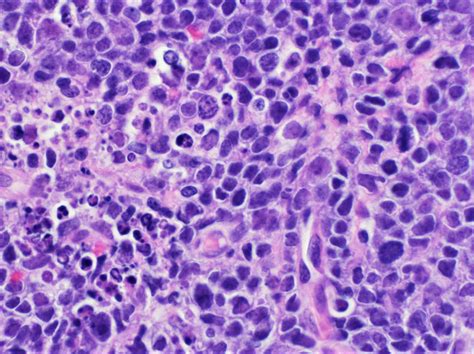 Pathology Outlines High Grade B Cell Lymphoma Nos