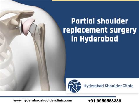 Partial Shoulder Replacement Surgery In Hyderabad Shoulder Clinic