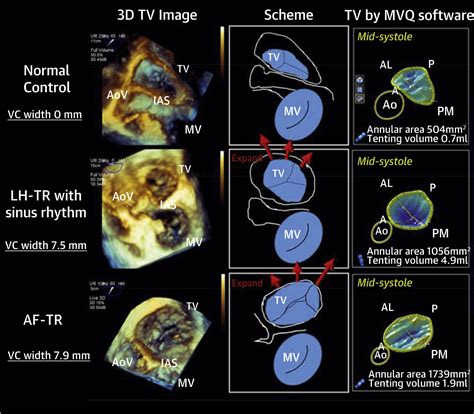 Transcatheter Tricuspid Valve Interventions Landscape Challenges And