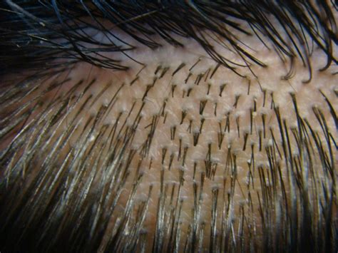 View Of Scalp Hair Demonstrating Follicular Units These Are Naturally Download Scientific
