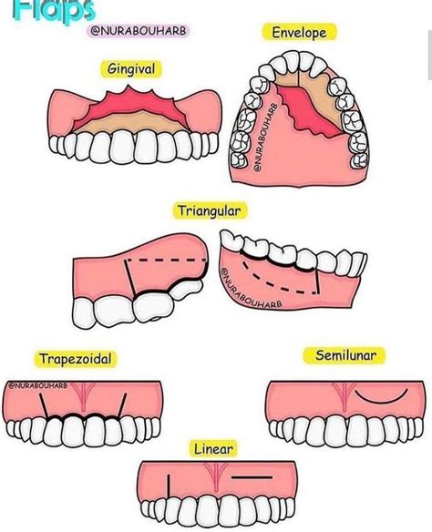 Types Of Flaps In Oral Surgery Medizzy