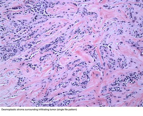 Pathology Outlines Lobular Carcinoma Pleomorphic Variant