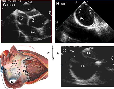 Transesophageal Echocardiography For Device Closure Of Atrial Septal
