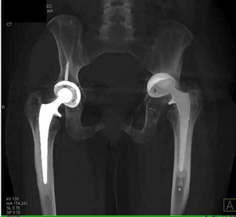 Failed Right Thr With Dislocated Hip Musculoskeletal Case Studies
