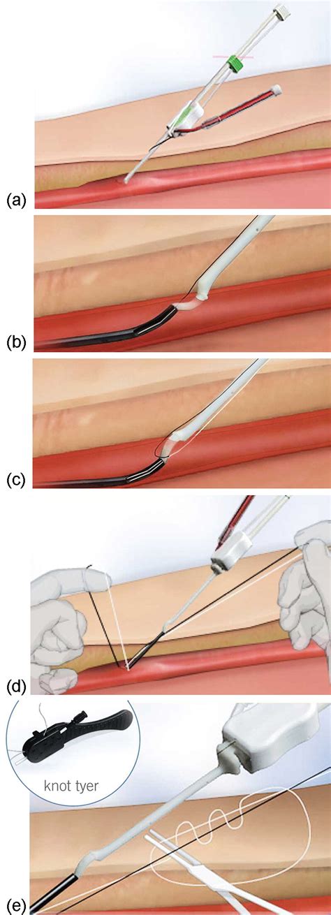 An Overview Of Vascular Closure Devices What Every Radiologist Should