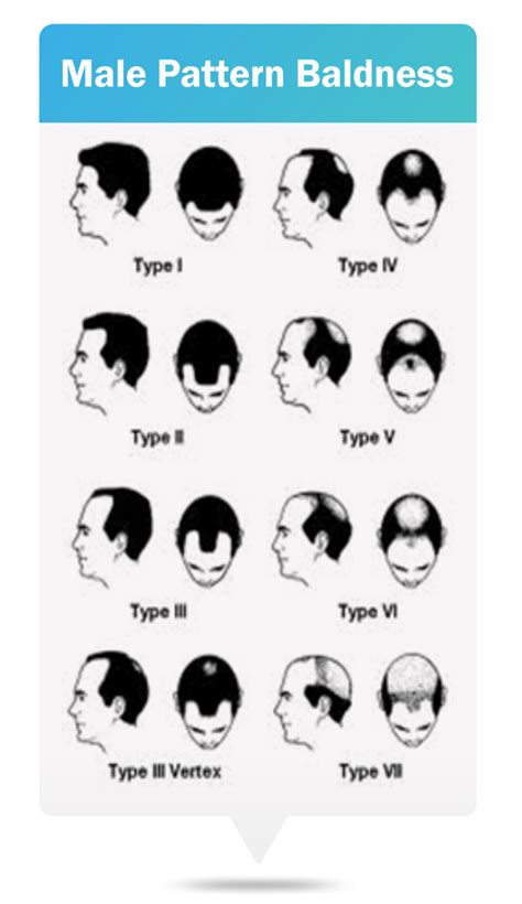 Male Pattern Baldness Symptoms Causes Treatment And Prevention Richfeel