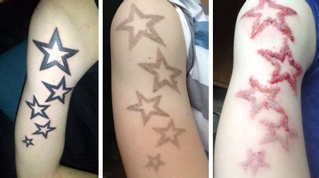 Your case will be considered by various boards who will determine whether you are a candidate for coverage and they will finally decide whether they can cover your treatment costs. Laser tattoo removal is on the rise, say skin experts ...