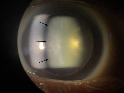 Cureus Massager Induced Anterior Subcapsular Cataracts And