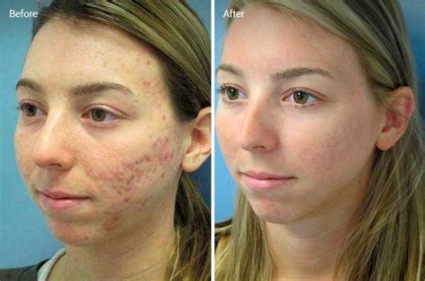 Laser Skin Resurfacing For Acne Scars Efficacy Before And Afters Cost