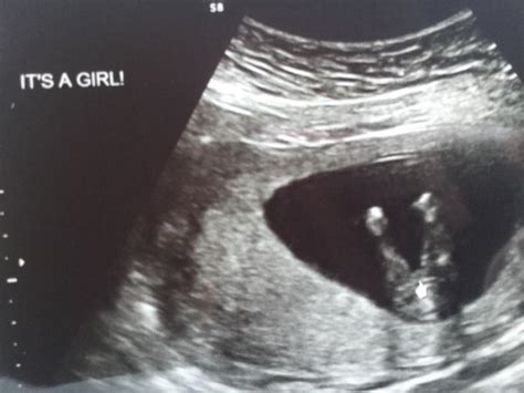 Baby Gender Ultrasound Near Me Get More Anythink S