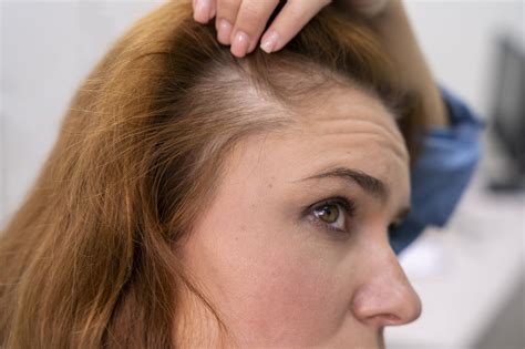 Alopecia Areata O Que E Como Tratar Dra Talita Siqueira