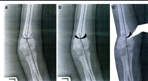Double Dome Osteotomy For The Treatment Of Cubitus Varus In Children