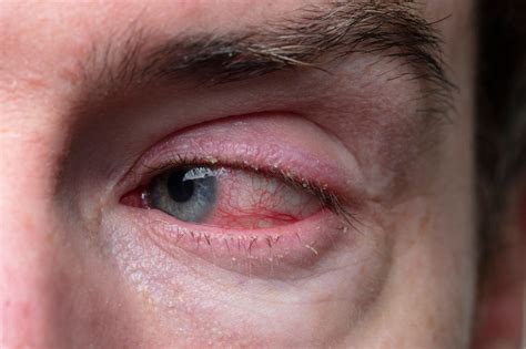 Itchy Crusty Or Inflamed Eyelids What Can You Do To Treat Blepharitis