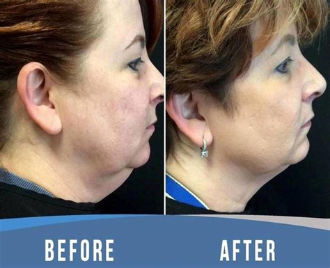 Thermage For Neck Before And After 5 Facelift Info Prices Photos