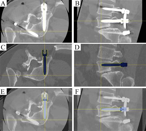 Screw Tip Tail And Angle Offset Assessment Postoperative CT Of L Download Scientific