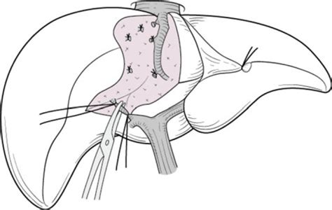 Sectionectomy Of The Liver Yamanaka 2012 Journal Of Hepato