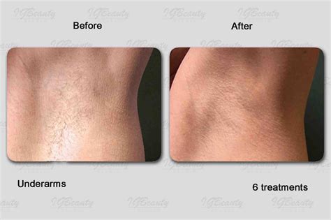 Female Body Laser Pubic Hair Removal Before And After Pictures