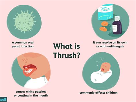 Oral Thrush Antifungal Cheapest Online Save 41 Jlcatjgobmx