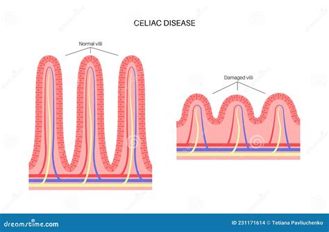 Celiac Disease Inflammation Stock Vector Illustration Of Villus