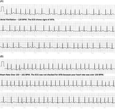 Example Of Two Electrocardiograms Ecgs In The Same 56 Year Old