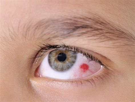 What Causes A Popped Blood Vessel In The Eye With Pictures