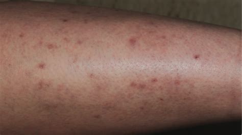 37 Year Old Female With Intractable Pruritus On Leg The Doctors