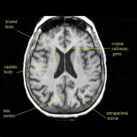 T In Corpus Callosum Corpus Brain Anatomy