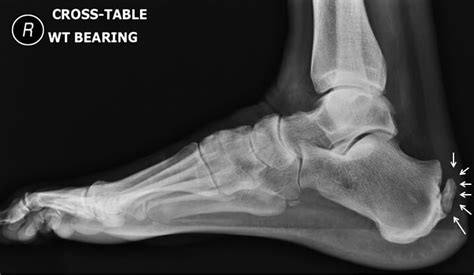 Achilles Tendon Pain Non Insertional Achilles Tendinopathy