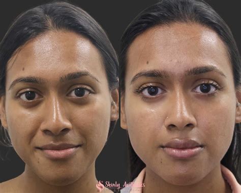 Smile Line Fillers Before And After Results At Skinly