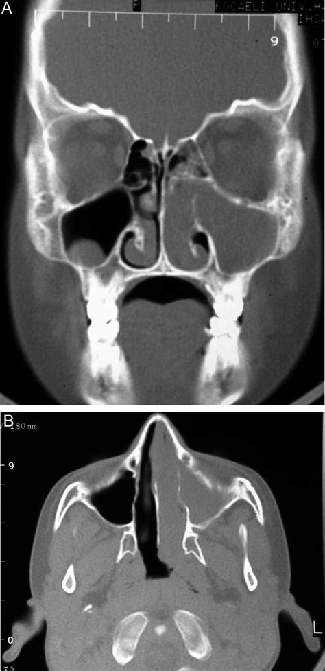 A Coronal Ct Scan Shows Total Opacification Of The Left Maxillary