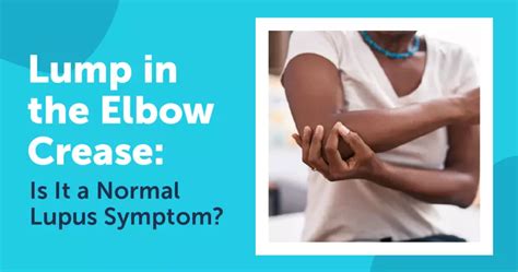 Lump In The Elbow Crease Is It A Normal Lupus Symptom Mylupusteam
