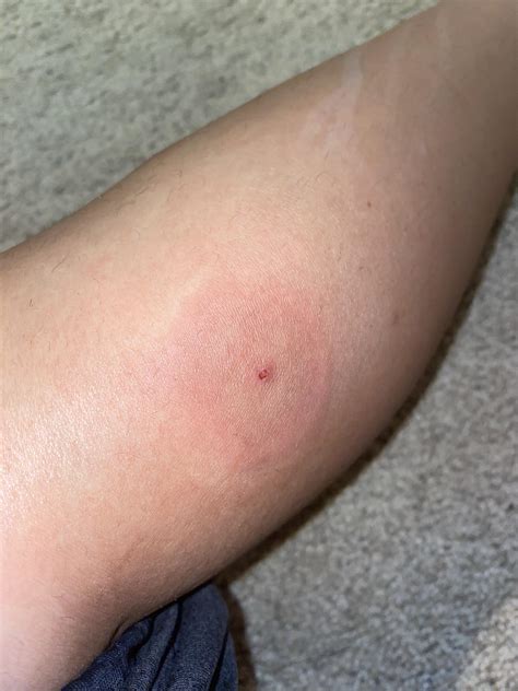 Infected Mosquito Bite Or Allergic Reaction Not Sure If This Is