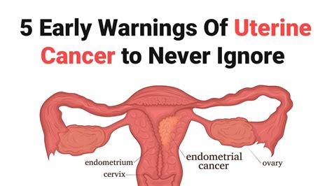 Endometriosis Cancer