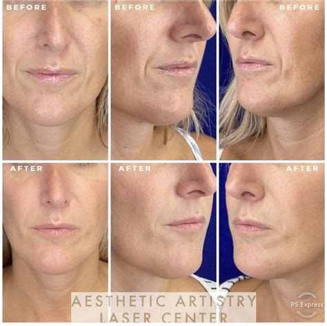 Annapolis Juvéderm Dermal Fillers Age Gracefully And Wrinkle Free