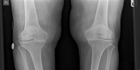 Bone On Bone Knee Pain Know Your Options Aro Motion