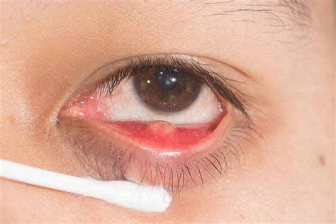 霰粒腫是什麼？與針眼的差異？霰粒腫的原因、治療一次搞懂！