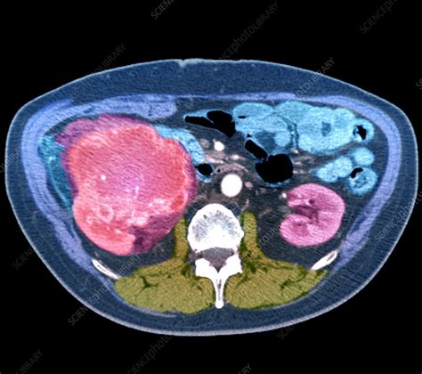Kidney Cancer Ct Scan Stock Image C0474985 Science Photo Library