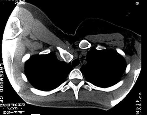 Sternoclavicular Joint Dislocation Radiology Reference Article
