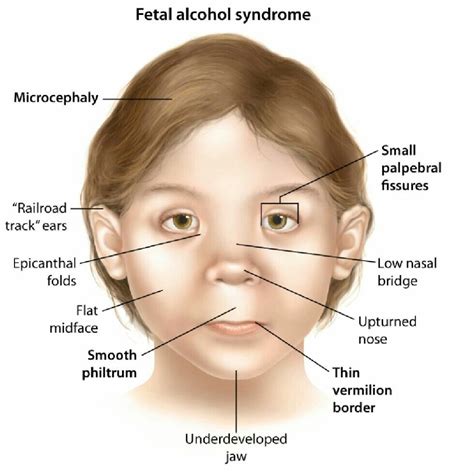 fetal alcohol syndrome causes symptoms and diagnosis
