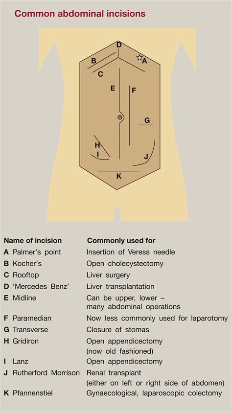 Palmers Point Entry Laparoscopy Safe Entry And How To Avoid