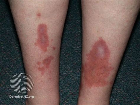 Diabetic Skin Lesions Rash Blisters Dermopathy Ulcers