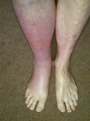 Диета для тромбоза глубоких вен Тромб в ноге: симптомы и первые признаки, лечение чем он опасен для жизни Тромб в ноге: симптомы и первые признаки, лечение чем он опасен для жизни Диета для тромбоза глубоких вен