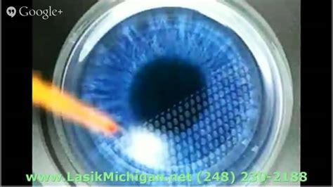 Top Rated Lasik Surgeons In Michigan Call Today YouTube