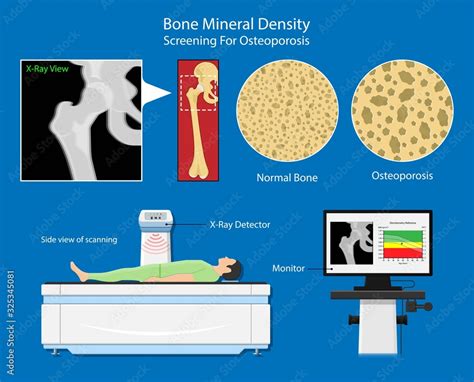 Vetor De Bone Mineral Density BMD Osteoporosis Dual Energy X Ray Absorptionmetry Adult Disease