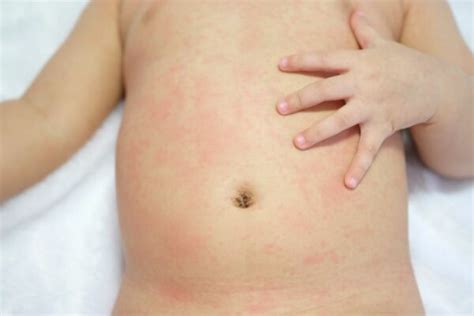 My Toddler Has An Itchy Red Scaly Rash Around The Belly Button What