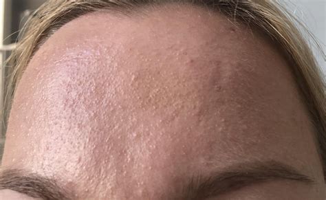 Do Yall Think This Is Fungal Acne Ive Tried Several Different Otc